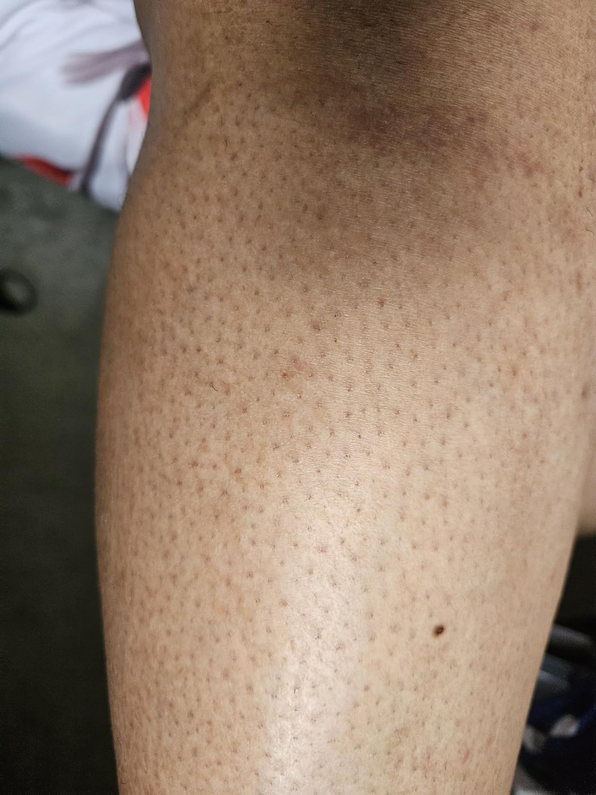 Ulike Laser Hair Removal Device Air 10 - Dual Lights, Skin Sensor & USHR Mode customer photo 1