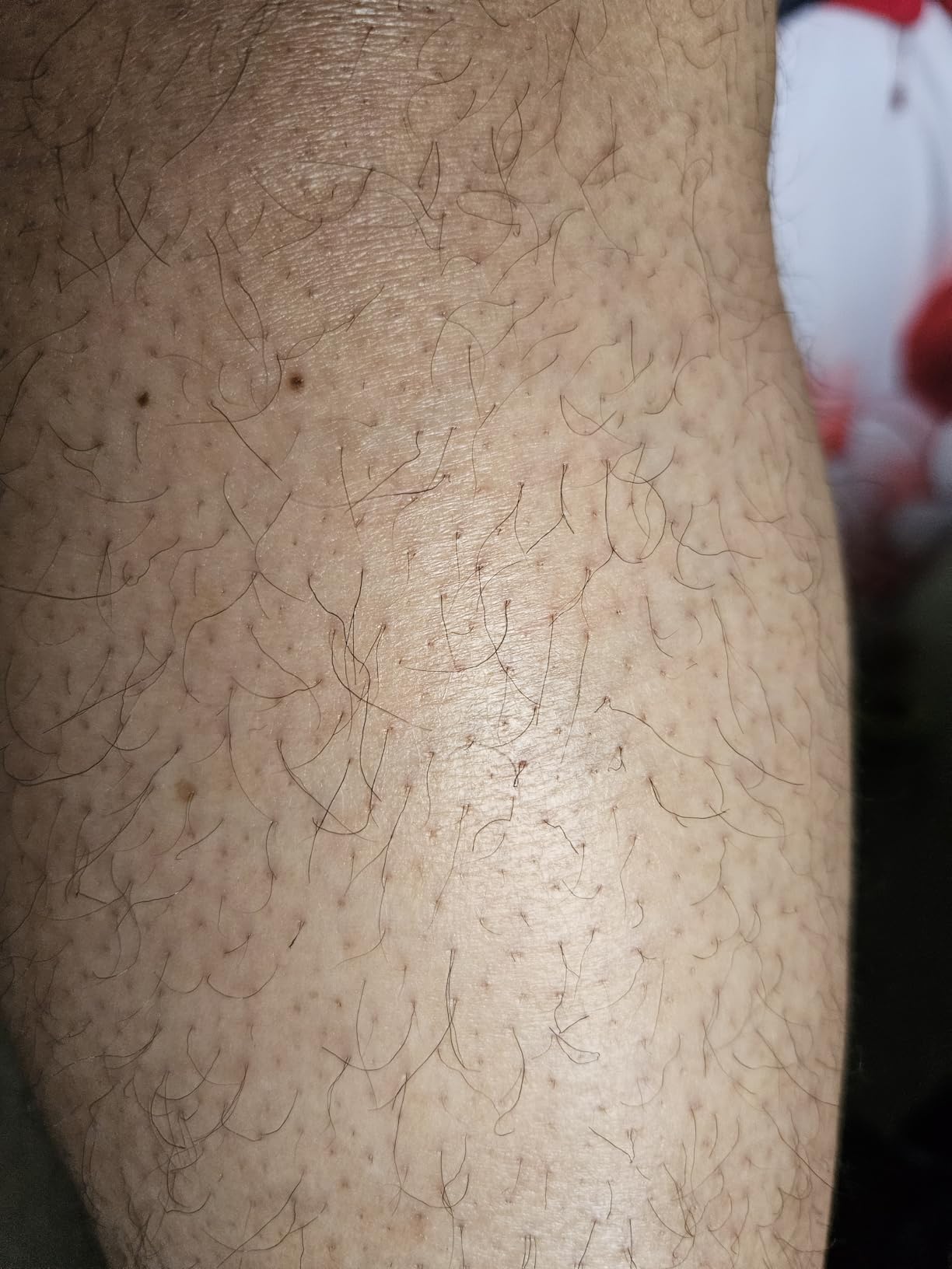 Ulike Laser Hair Removal Device Air 10 - Dual Lights, Skin Sensor & USHR Mode customer photo 2