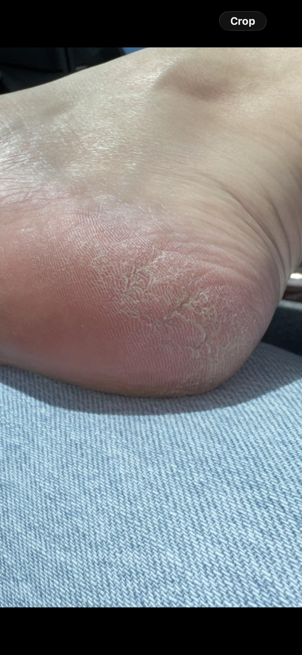 Ebanel Urea Cream 40% plus Salicylic Acid 2% for Dry Cracked Feet Skin | Deeply Moisturizes & Softens Dry Cracked Heels, Feet, Knees, Elbows, Hands, Rough Dead Skin Callus Remover Toenail Softener customer photo 1