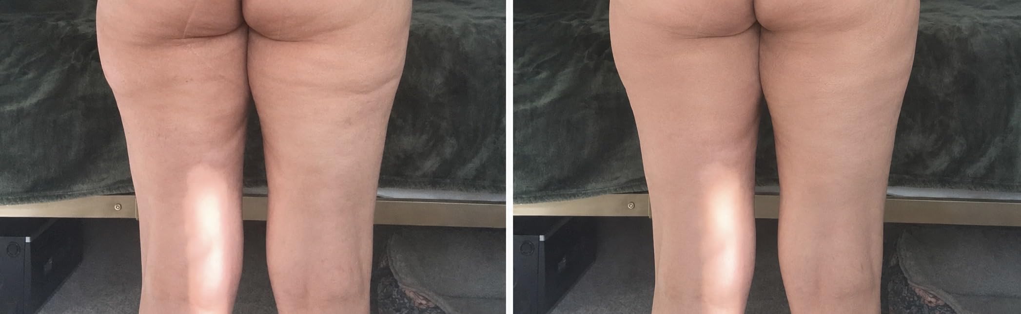 Radio Frequency Induced Heat-Palm NRG Cellulite Body Device customer photo 1