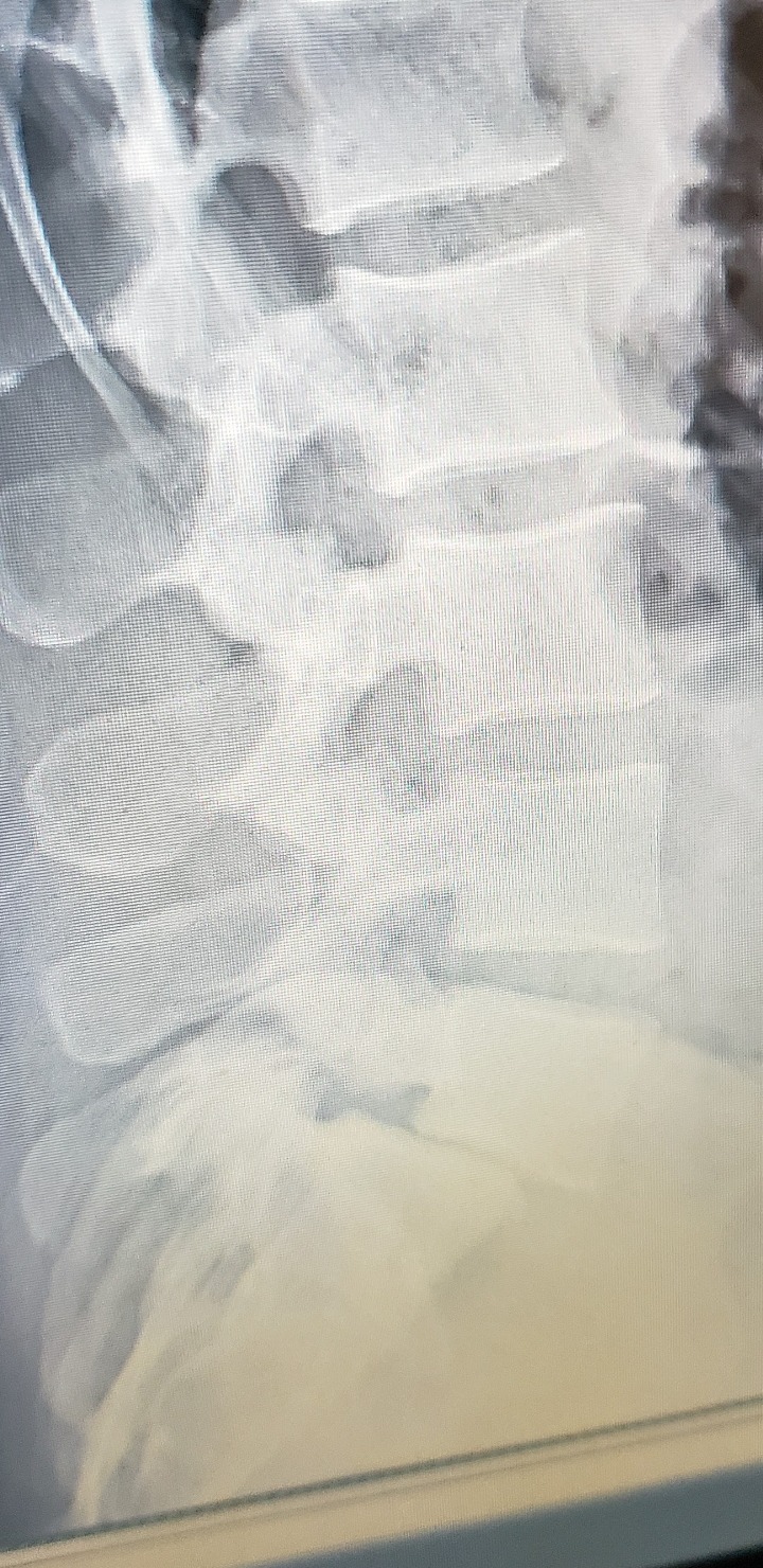 BraceAbility LSO Back Brace for Women and Men - Medical-Grade Lumbar Brace for Herniated Disc, Sciatica, Spinal Stenosis, Spondylolisthesis, Post-Surgery Recovery, Hot and Cold Therapy (M) customer photo 2